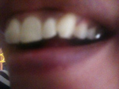 歯のホワイトニングは詰めている部分は白くならないと言われました