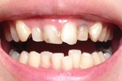 前歯がまばらなのと、歯肉と歯の隙間の黒い歯石のようなものが気になる