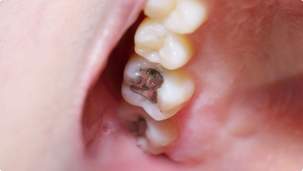 虫歯の治療跡の特徴と原因
