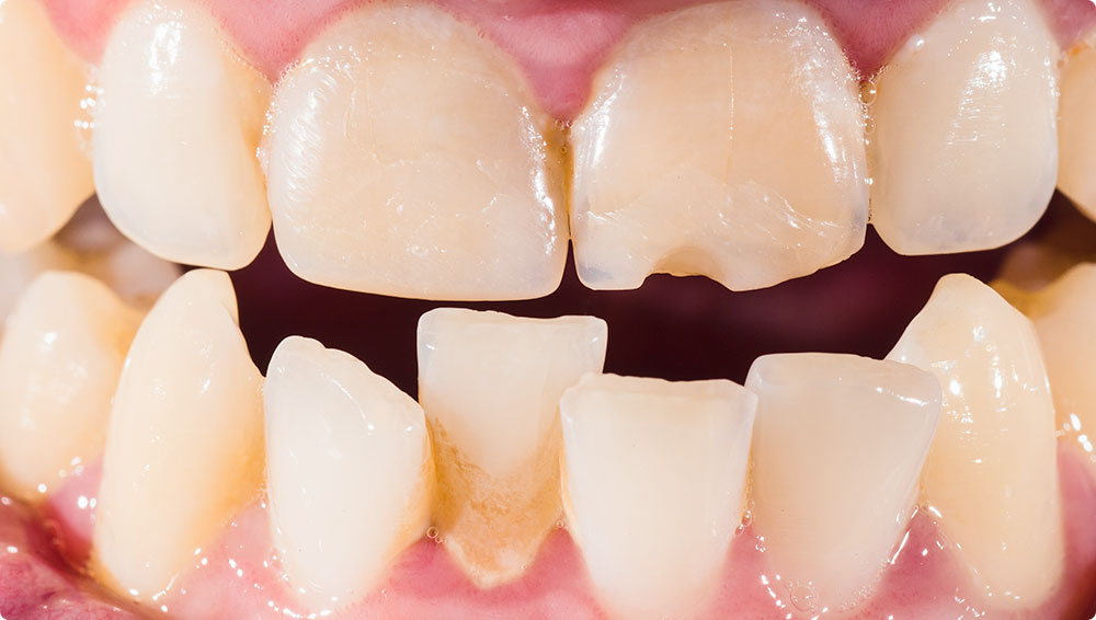八重歯・叢生（そうせい）・乱杭歯の特徴と原因