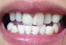 治療後の歯の歯並びについて