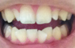 どういう歯列矯正になりますか？ 抜歯はあり？