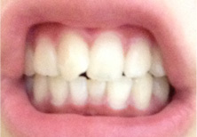 前歯1本だけ曲がっている、部分矯正かオールセラミックか…