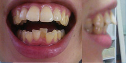 上前歯の出っ歯と、下前歯4本の歯並びが悪い、セラミッククラウンか矯正か