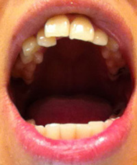 片方の前歯が重なった横の歯に押されてどんどん前に出てきます