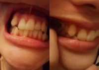 八重歯を治し歯並びを綺麗にしたい。短期間の施術の金額