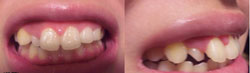 右前歯の横の変な向きに生えている歯を綺麗に