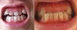 上顎の前歯3本が内側に入って。歯の色も気になる