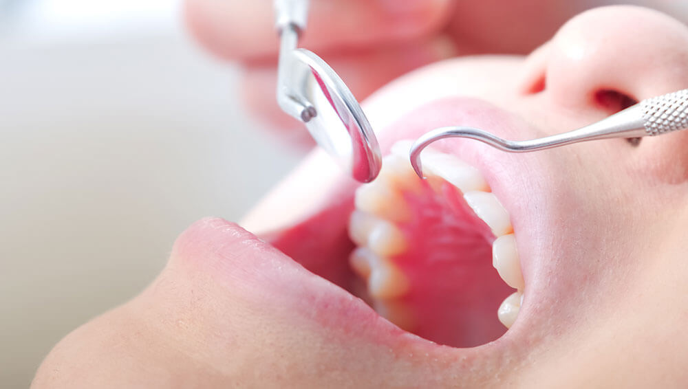 口腔内定期検診