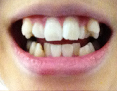 上と下の歯の八重歯で悩んでいます。部分矯正は？