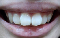 前歯2本をセラミッククラウンで治す場合の治療期間は？