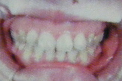 黄色い歯を白くしたいのと、笑った時に見える歯肉を治したい