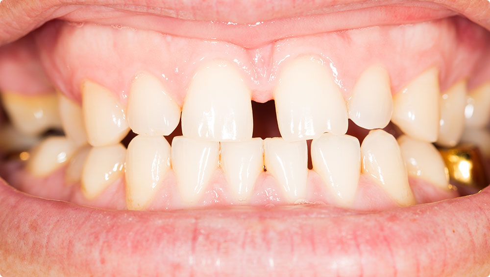 すきっ歯（正中離開、空隙歯列）の特徴と原因