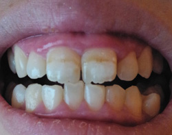 レジン（保険内）ですきっ歯の治療は可能？