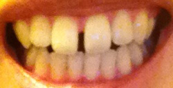 ラミネートベニアですきっ歯の治療