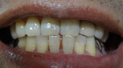 下の前歯のすきっ歯