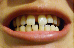 上の前歯のすきっ歯の治療は、ラミネートベニア可能？ 下の前歯もおなじなら矯正のほうが良いですか？