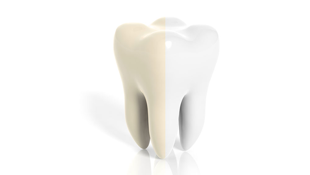 生まれつきの歯の変色、テトラサイクリン、ホワイトスポットの特徴と原因