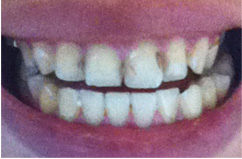 治療跡や黄ばんだ歯…歯を全体的にきれいにしたい