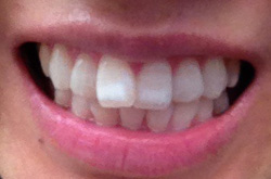 歯の変色（ホワイトスポット）、ラミネートベニアの強度は？