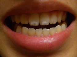 斑状歯（ホワイトスポット）の治し方、悪化させない方法
